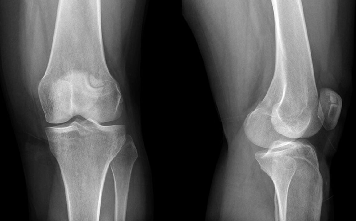 L'arthrose du genou sur le rayon x avant l'utilisation de l'orbite